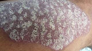 Psoriasis rash pictures skin condition disorder dry skin images symptoms [upl. by Jenness]