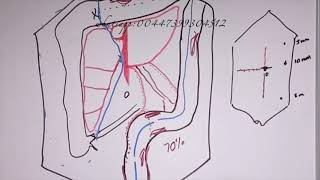 Right hemicolectomy أستئصال الجزء الأيمن من القولون [upl. by Nirej]