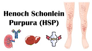 Henoch Schoenlein Purpura HSP  Causes Pathophysiology Diagnosis And Treatment [upl. by Ahsiem]