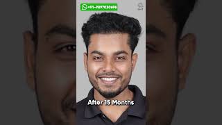 Fifteen Months Hair Transplant Results  Latest Fue Technique shorts viralvideo hair transplant [upl. by Salchunas]