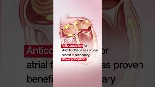 Apixaban to Prevent Recurrence After Cryptogenic Stroke in Patients With Atrial Cardiopathy [upl. by Yrahca]