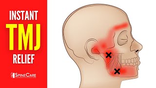 How to Relieve TMJ Pain at Home  30 SECOND RELIEF [upl. by Inaluiak]