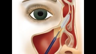 FinESS Balloon Sinus Dilation in the office under local anesthesia  Richmond ENT [upl. by Donnelly871]