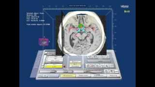 Virtual Reality planning of skull base surgery Tuberculum sellae meningioma [upl. by Dyol96]