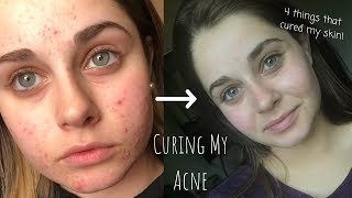 HOW I CLEARED MY ACNE  CYSTIC ACNE  Skincare Queen [upl. by Furnary]