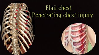 Penetrating chest injury  Flail chest  Flail Chest  General Characteristics  part 5 [upl. by Asaph753]