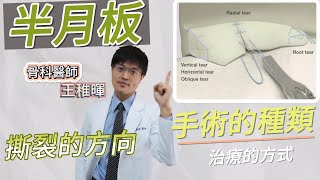 【半月板系列】半月板撕裂的方向｜手術的種類｜其他治療的方式｜王稚暉醫師 [upl. by Ermin]