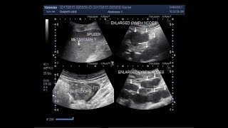 Ultrasound Video showing enlarged abdominal lymph nodes with ascites and a metastasis in spleen [upl. by Helbonnas]