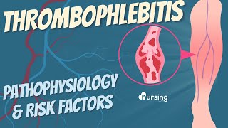 Thrombophlebitis Pathophysiology amp Risk Factors Nursing [upl. by Hulton]