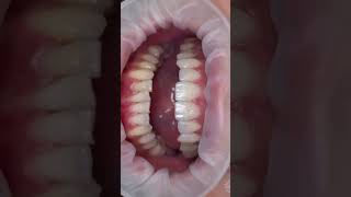 Minimal preparation veneers [upl. by Adolphus]