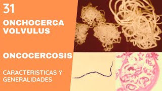 ONCHOCERCA 31  ONCOCERCOSIS  NEMATODOS [upl. by Lynsey]