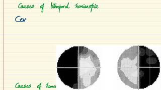 Ocular signs  Bitemporal Hemianopia and Homonymous Hemianopia [upl. by Buffy]