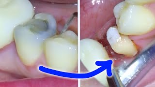 Full Dental Crown Procedure After a Root Canal On a Molar Permanent amp Temporary Tooth Cap Guide [upl. by Rodmun925]