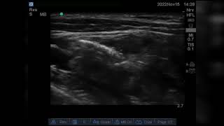 Ultrasound guided Costoclavicular brachial plexus block [upl. by Litha]