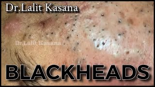 Best of Blackheads Removal by Dr Lalit Kasana  Repost [upl. by Ecam]