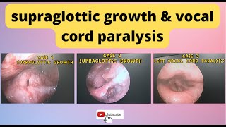 supraglottic growth  vocal cord paralysis  70degree endoscopy [upl. by Aker]