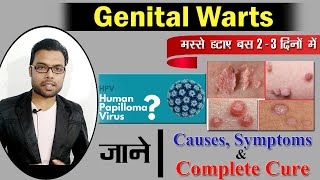 मस्से को जड़ से ख़त्म करने का 100 इलाज  Genital warts treatment in hindi  Warts ka ilaj  Dr Nitish [upl. by Refinaj]