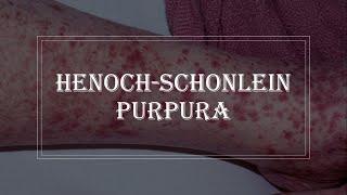 HenochSchonlein Purpura  purple rash on skin vasculitis [upl. by Marolda]