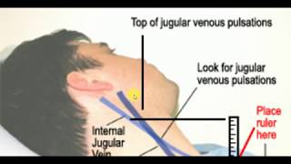 JUGULAR VENOUS PRESSURE  MEDICINE LECTURES  Cardiology Lectures [upl. by Aillicec734]