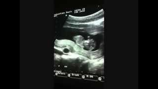 pregnancy 11 weeks 4 days ultrasound [upl. by Radborne284]