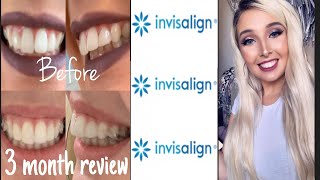 Invisalign Overbite Correction  3 Month Review With Before amp After Pics [upl. by Hope]