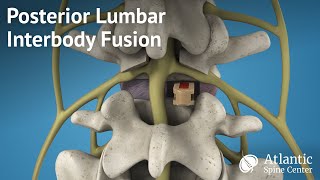 Posterior Lumbar Interbody Fusion PLIF [upl. by Nimzay]