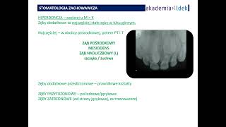 LDEK nieprawidłowości zębowe hipodoncja taurodontyzm turnera i inne [upl. by Annoiek]