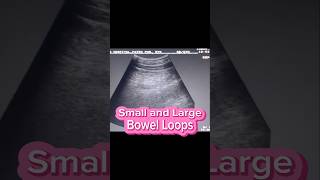 Prominent Bowel Loops  Enteritis  Colitis  Bowel Obstruction on Ultrasound [upl. by Nylorac539]