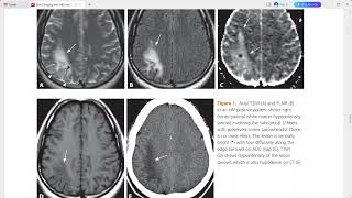 BRAIN IMAGING WITH MRI AND CT [upl. by Mokas]