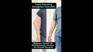 Yanlış Kaynayan Dirseğinize Veda Edin [upl. by Welton]