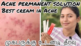 ✨Acne permanent solution✨முகபருக்கு உடனடிதீர்வு✨Best cream in Acne✨acne sheelaanuofficial5202 [upl. by Strohl857]