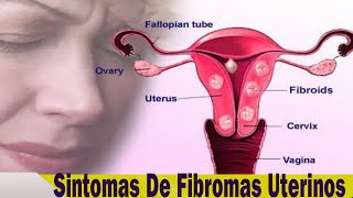 Fibromas Uterinos 10 Señales De Que Tienes Fibromas Uterinos [upl. by Alahsal673]