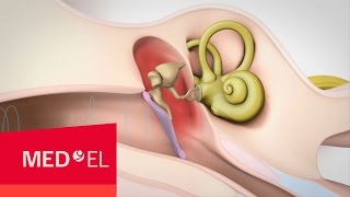 Conductive Hearing Loss Explained  MEDEL [upl. by Sidnal]