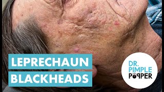 Blackhead Blackheads amp Blackheads Extended Leprechaun Blackheads [upl. by Phare484]