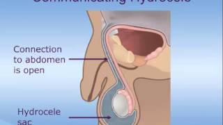 Hydrocele Repair In Children [upl. by Erin]