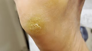 Professional treating cracked  Cracked treatment amp Callus removal  ASMR [upl. by Alves]