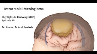 Radiology of Meningioma Highlights in Radiology HIR Episode 15 [upl. by Nirrak]