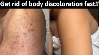 How to get rid of body hyperpigmentationdark spots dark knucklesmelasmascars FAST even skin [upl. by Jacquelyn]