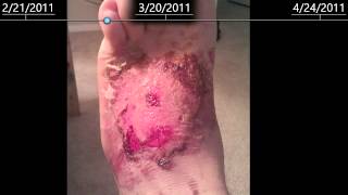 2nd Degree burns on foot  healing time lapse  2 months [upl. by Marchelle]