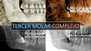 Wisdom teeth  Inferior alveolar nerve  Nervio dentario inferior cirugiabucal tercermolar [upl. by Ottavia]