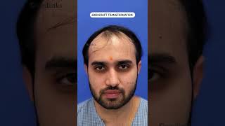 Hair Transplant Results  4000 Grafts Hair Transplant  Medlinks hairtransplantresults shortsfeed [upl. by Grigson]