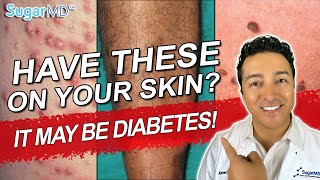 12 Diabetic Skin Problems amp Top Signs of Diabetes on The Skin [upl. by Gershon]