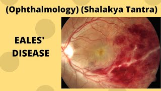 EALES DISEASE Ophthalmology Shalakya Tantra [upl. by Eleahcim]