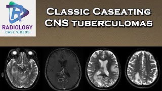 Classic Caseating CNS tuberculomas [upl. by Redford230]