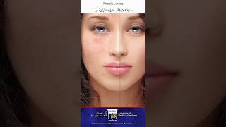 What is Acne  Dr Masoods Homoeopathic Remedies for Acne pimples  No side effect acne skin [upl. by Uta975]