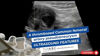 A thrombosed Common femoral artery pseudoaneurysm ultrasound features [upl. by Annoyk68]