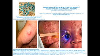 HUMAN M pox Monkeypox Infection And Morbidity Persist Since The Recent Global Outbreak [upl. by Korney950]