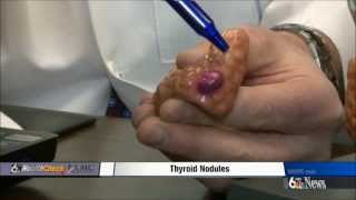 Thyroid Nodules [upl. by Franz267]