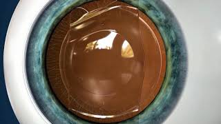 Vision Correction for High Levels of Myopia amp Astigmatism [upl. by Wolenik]