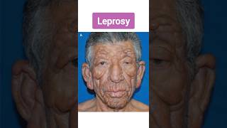 Leprosy  कुष्ट रोग का पूरा इलाज़ संभव है  यह परेशानी आपके हाथों को पूरा ख़राब कर देता है  leprosy [upl. by Acirre]